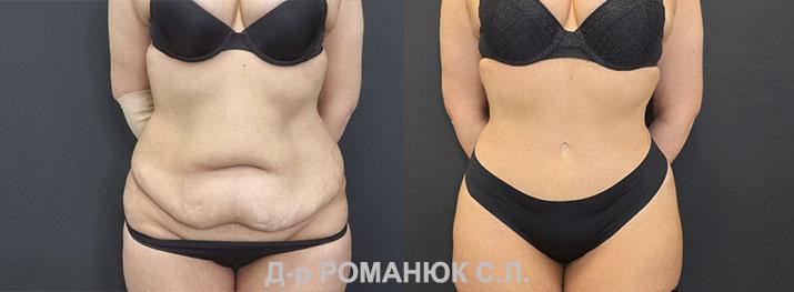 Пластика живота в Одессе