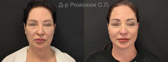 Подтяжка лица и шеи в Одессе