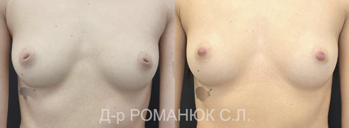 Коррекция сосков и широкой ареолы в Одессе
