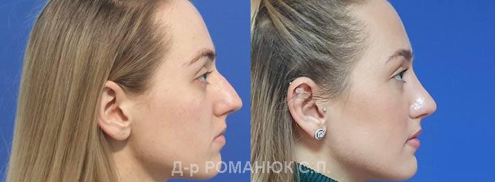 Ринопластика (пластика носа) в Одессе