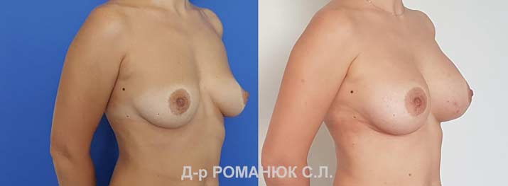 Увеличение груди в Одессе