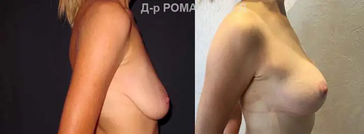 Подтяжка груди в Одессе
