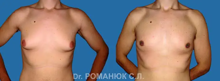 Хирургическое лечение гинекомастии в Одессе