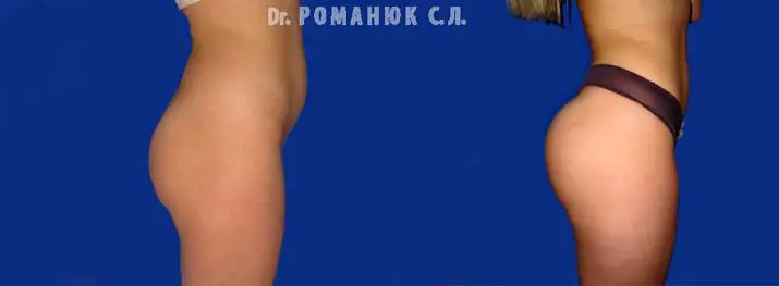 Пластика бедер и ягодиц в Одессе