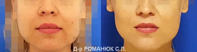 Удаление комков Биша в Одессе