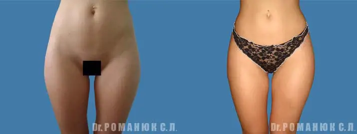 Липосакция, липоскульптура в Одессе