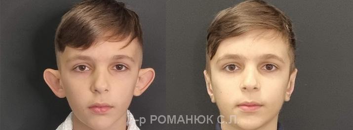 Пластика ушей в Одессе