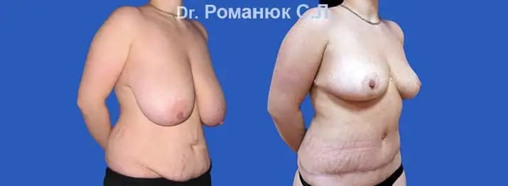 Уменьшение груди в Одессе