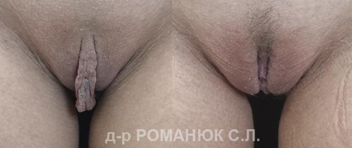 Пластика половых губ (интимная пластика) в Одессе