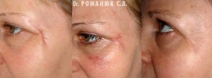 Лечение рубцов в Одессе